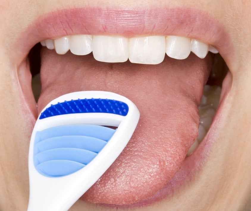 White coated tongue